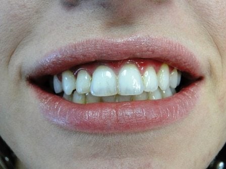 after-clear braces
